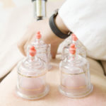 Closeup of acupuncture therapist removing glass globe in a fire cupping treatment