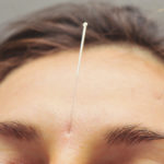 close up of acupuncture needles in a woman's forehead